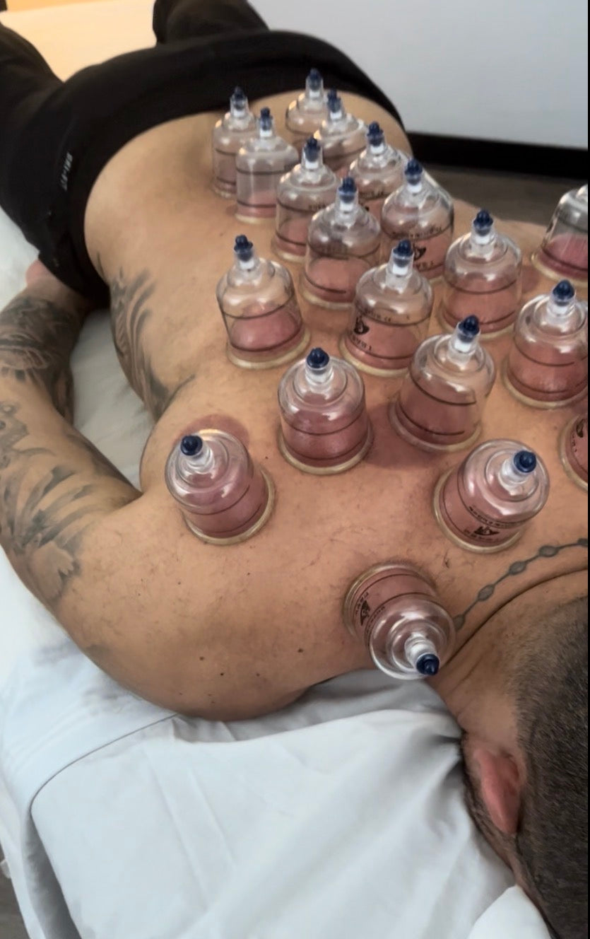 Cupping Therapy